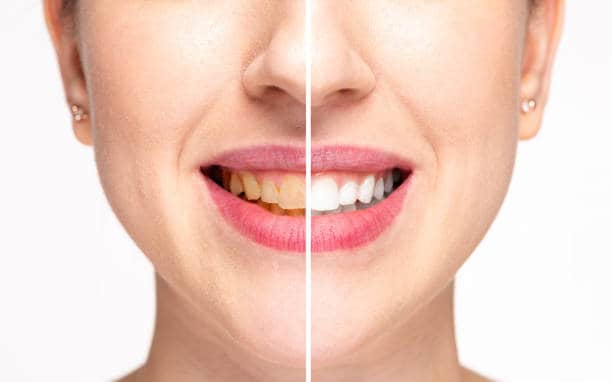 Teeth Whitening Milton Keynes Northampton