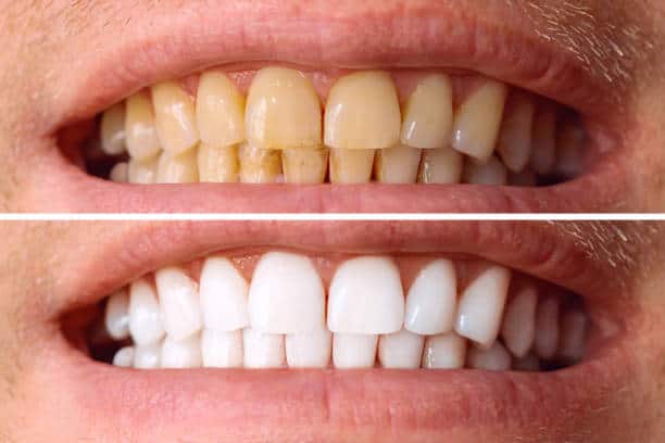 Laser White For Ever Bright – Get a Brighter, Whiter Smile with LA Teeth Whitening Northampton