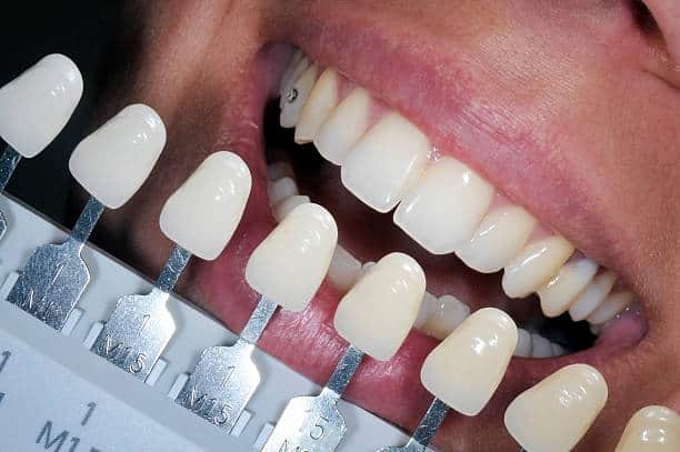 Get Natural and Stunning Smile with Teeth Whitening Results from LA Teeth Whitening Northampton