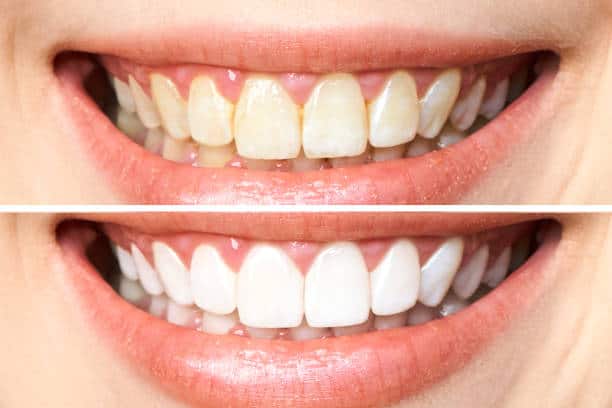 Achieve a Dazzling Smile for Your Special Day: A Guide to Wedding Teeth Whitening Northampton