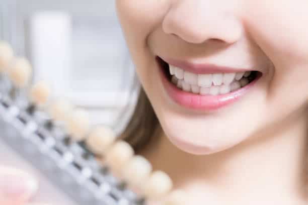 Teeth Whitening Kings Norton Northampton