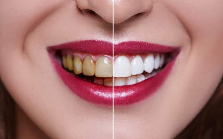 Teeth Whitening Ascot Windsor Northampton